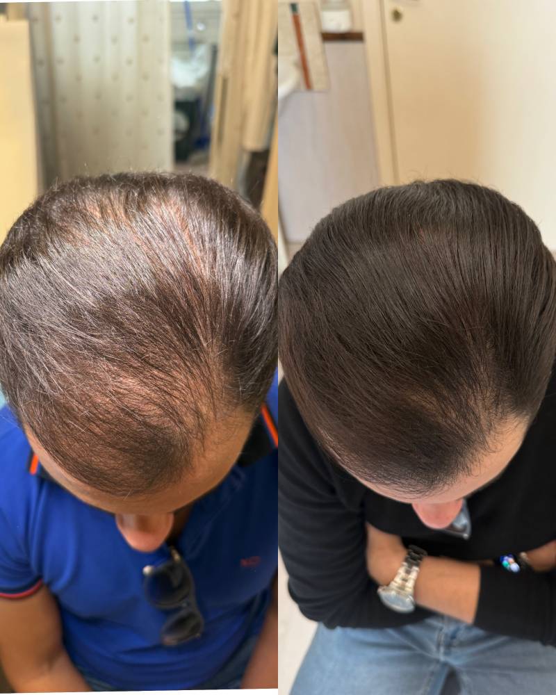 terapia-caduta-capelli