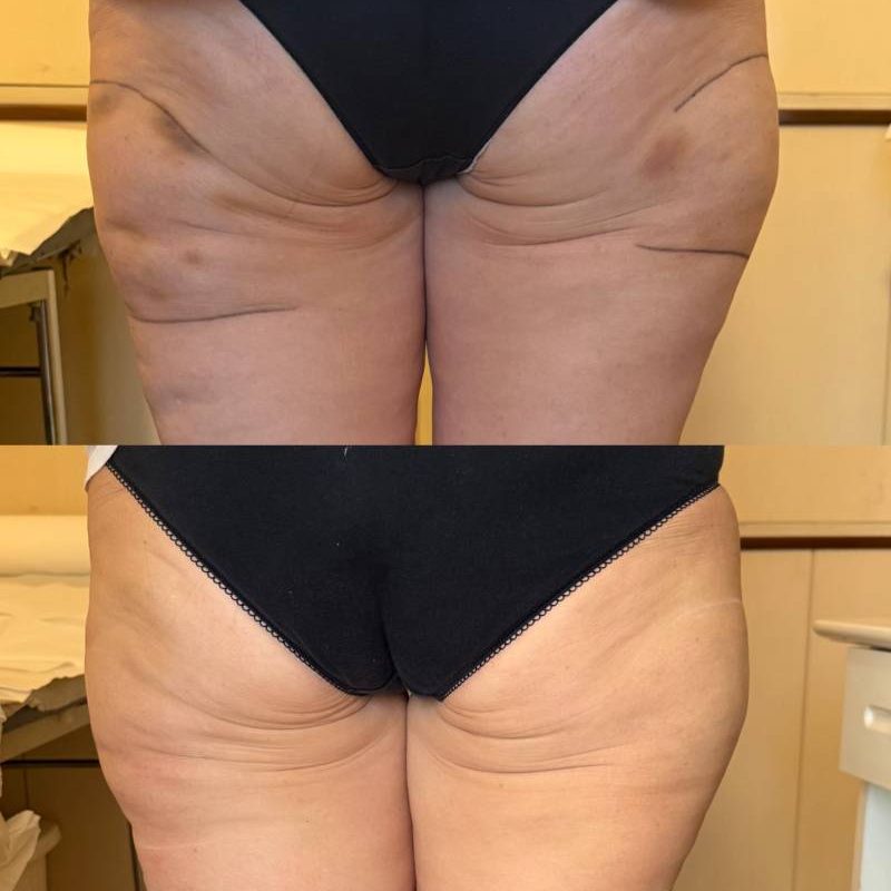 cellulite-1