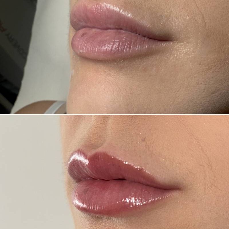 filler-1