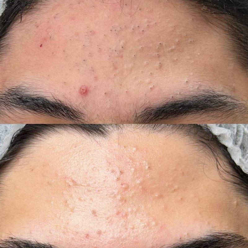 peeling-1