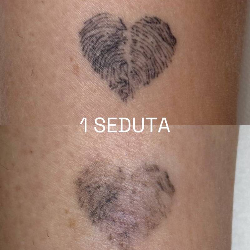 rimozione-macchie-tatuaggi-2